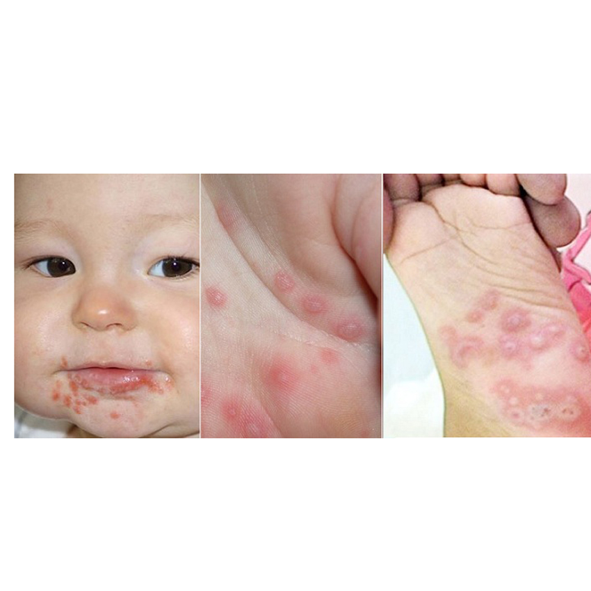 4 bước chăm sóc trẻ bệnh tay chân miệng