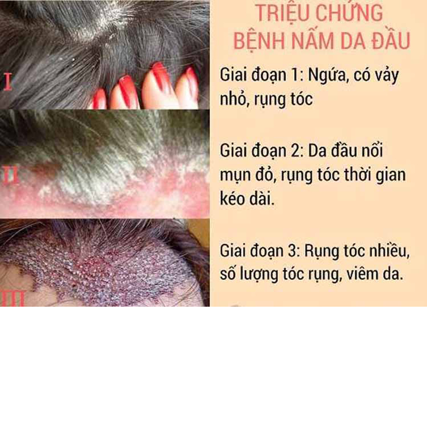 8 cách trị nấm da đầu pháp dân gian