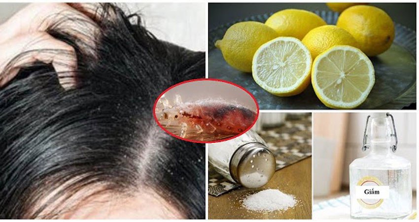 10 cách trị chấy rận hiệu quả tại nhà