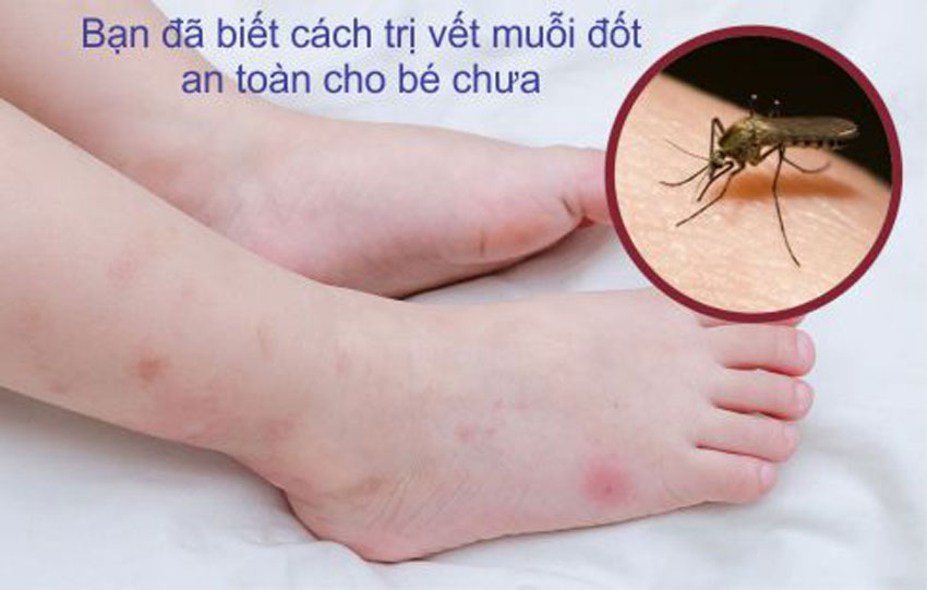 15 cách trị muỗi đốt cho bé