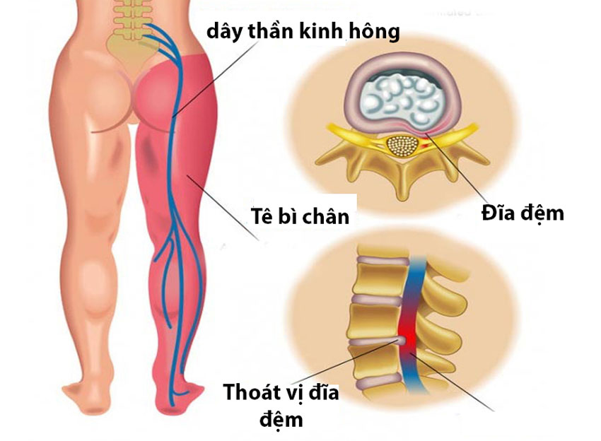 Tê bì tay chân là dấu hiệu của bệnh gì