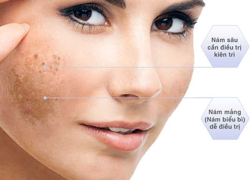 6 cách trị nám da bằng sữa chua tại nhà