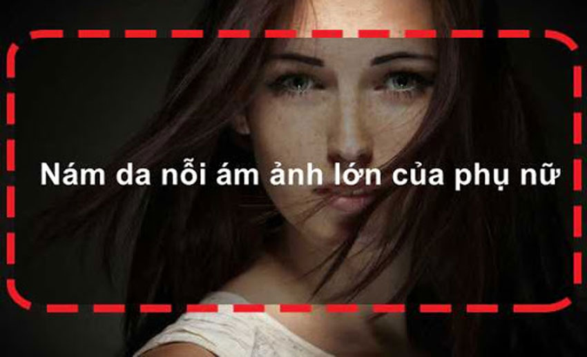 6 cách trị nám da bằng sữa chua tại nhà