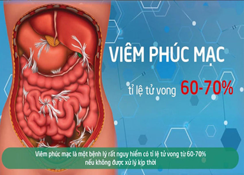 Dấu hiệu nhận biết bạn bị viêm ruột thừa