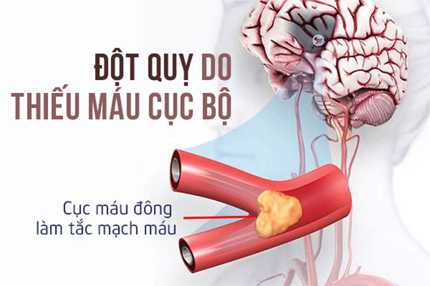 Bệnh thiếu máu não có nguy hiểm không?