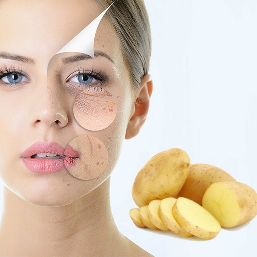 7 cách trị nám da tại nhà bằng phương pháp thiên nhiên