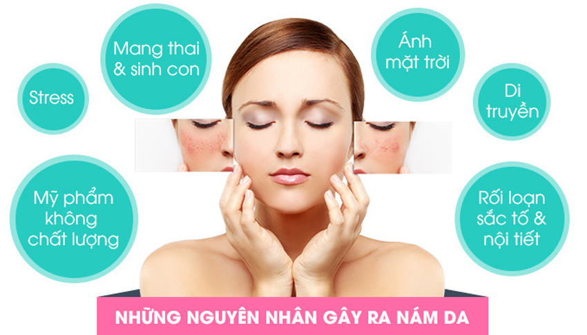 7 cách trị nám da tại nhà bằng phương pháp thiên nhiên