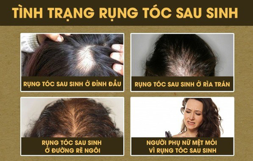 4 cách trị rụng tóc sau sinh tại nhà hiệu quả
