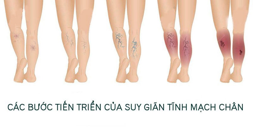7 Cách trị suy giãn tĩnh mạch chân tại nhà