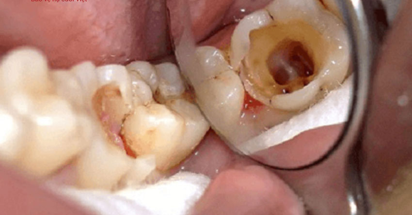 6 cách chữa sâu răng tại nhà hiệu quả