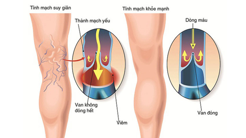 7 Cách trị suy giãn tĩnh mạch chân tại nhà