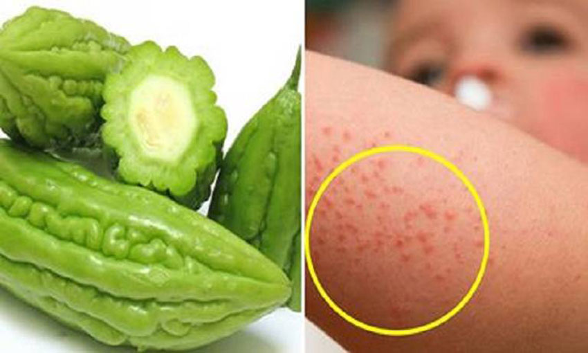 8 cách trị rôm sảy cho bé vào mùa hè cực hay