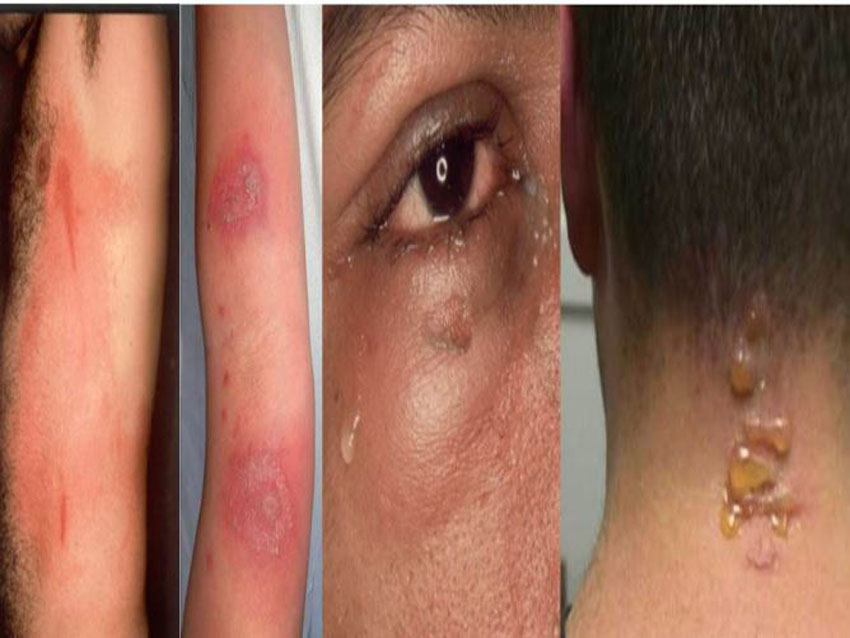 6 bước xử lí khi bị kiến ba khoang đốt