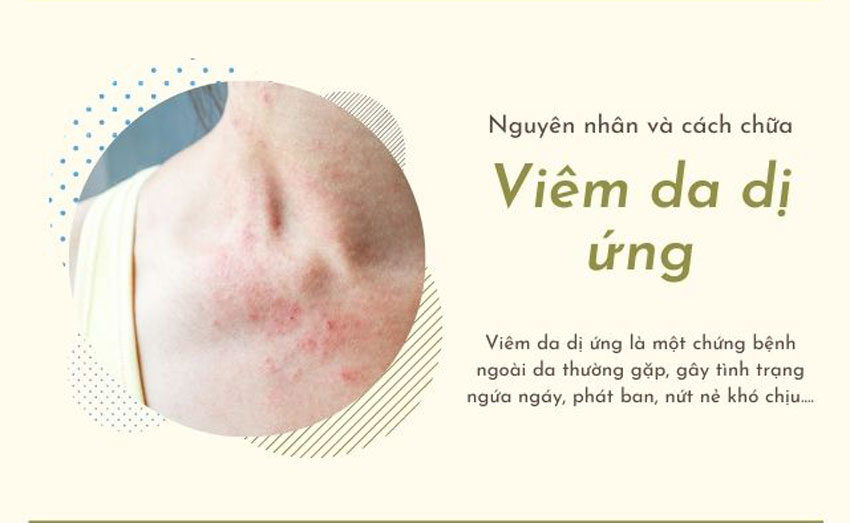 10 Cách chữa dị ứng da tại nhà hiệu quả