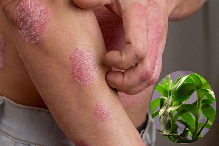 Cây lược vàng và 3 cách chữa vảy nến hiệu quả