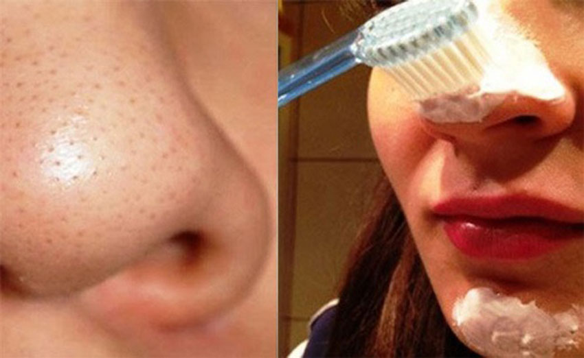 6 cách trị mụn đầu đen hiệu quả tại nhà