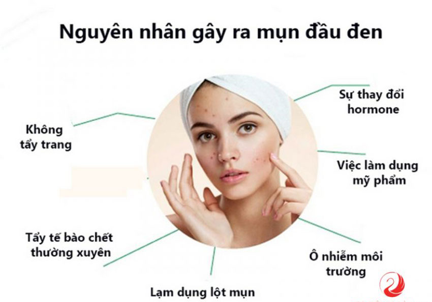 6 cách trị mụn đầu đen hiệu quả tại nhà