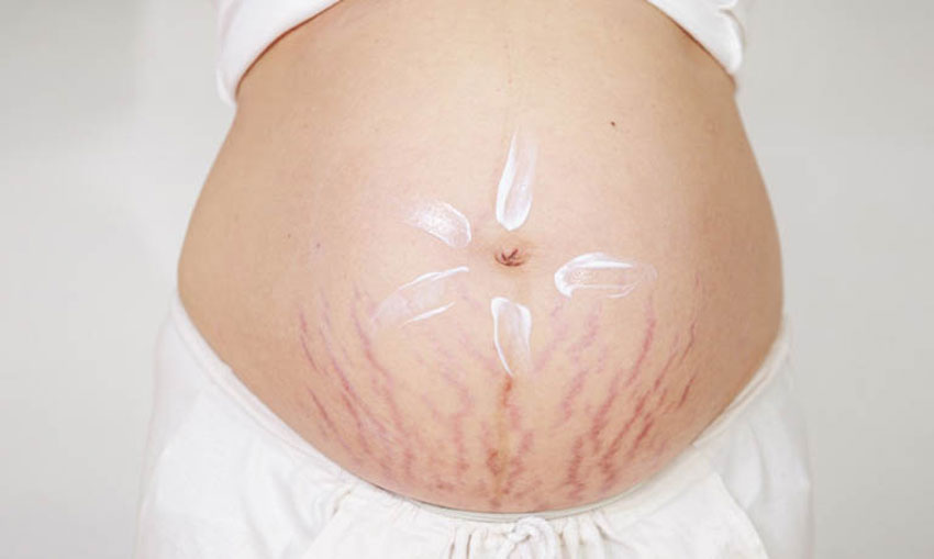 8 cách trị rạn da bằng phương pháp tự nhiên