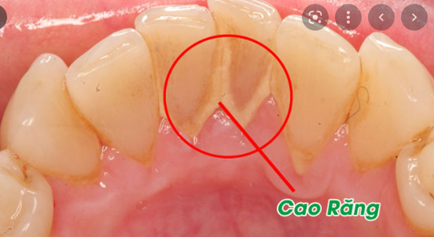 8 cách lấy cao răng bằng nguyên liệu tự nhiên