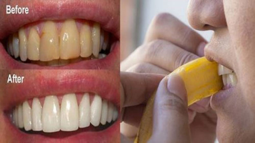 8 cách lấy cao răng bằng nguyên liệu tự nhiên