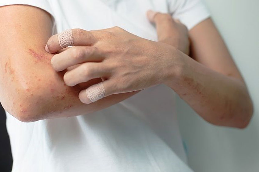 4 cách chữa dị ứng thực phẩm tại nhà