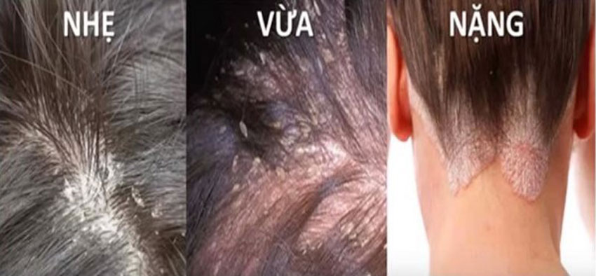 4 cách trị nấm da đầu tại nhà hiệu quả