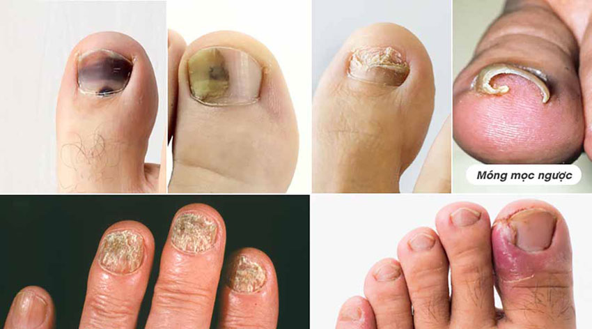 8 cách trị nấm móng chân tay tại nhà hiệu quả