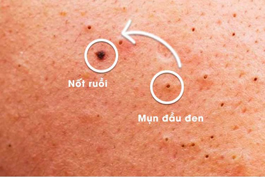 Tẩy nốt ruồi nên kiêng 5 thực phẩm này