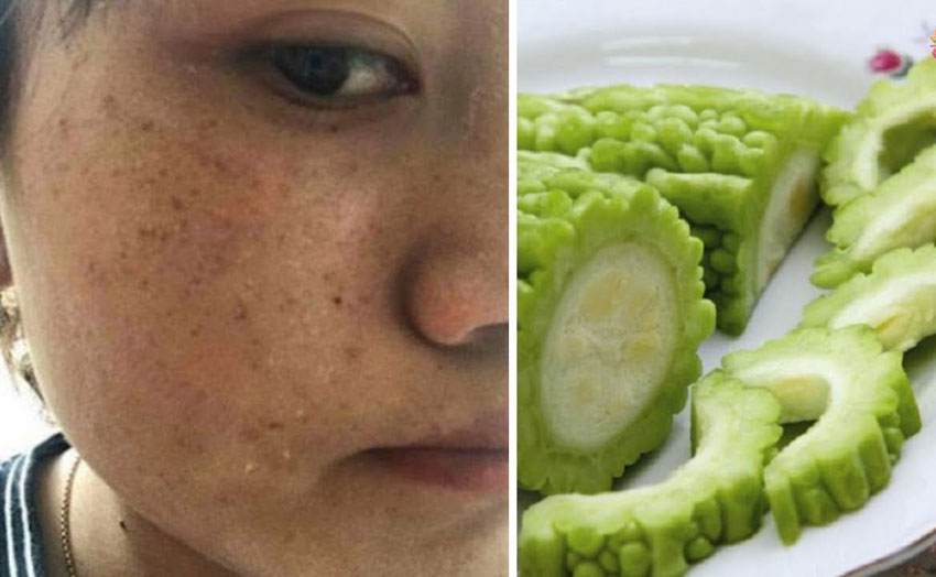 6 cách trị tàn nhang bằng mướp đắng hiệu quả