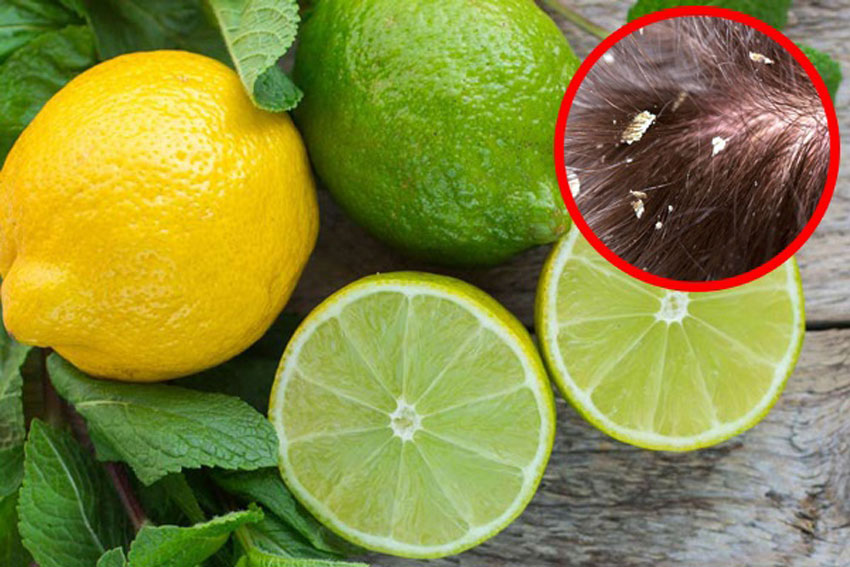 6 Cách trị gàu bằng chanh hiệu quả