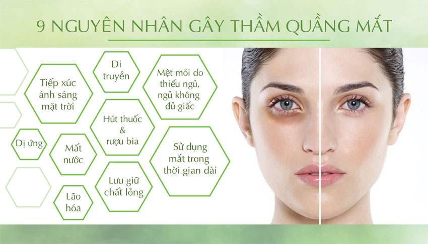 8 Cách trị thâm quầng mắt tại nhà hiệu quả